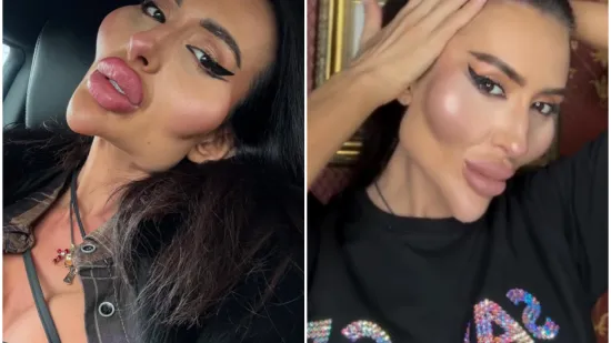 Žena s najvećim obrazima u dugotrajnom je procesu otapanja filera: Promjene su već vidljive